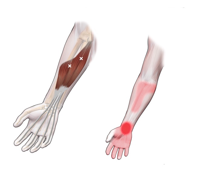 Flexor digitorum superfascialis en profundus-Sp-T