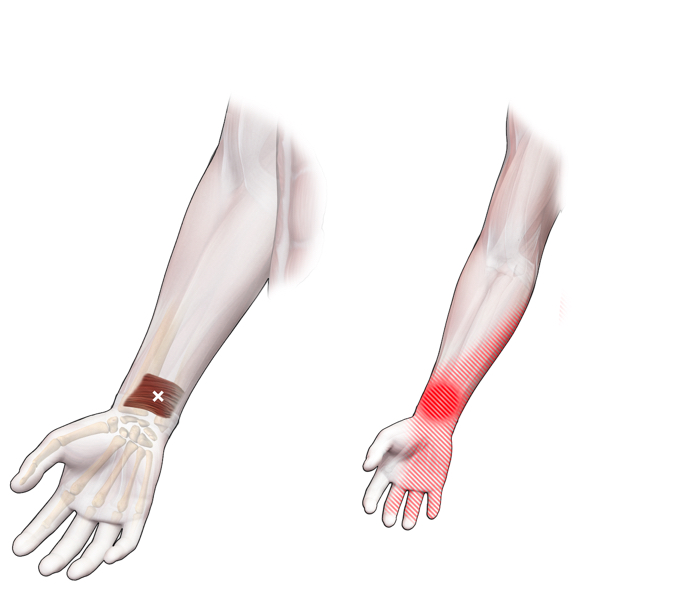 Pronator quadratus-Sp-T