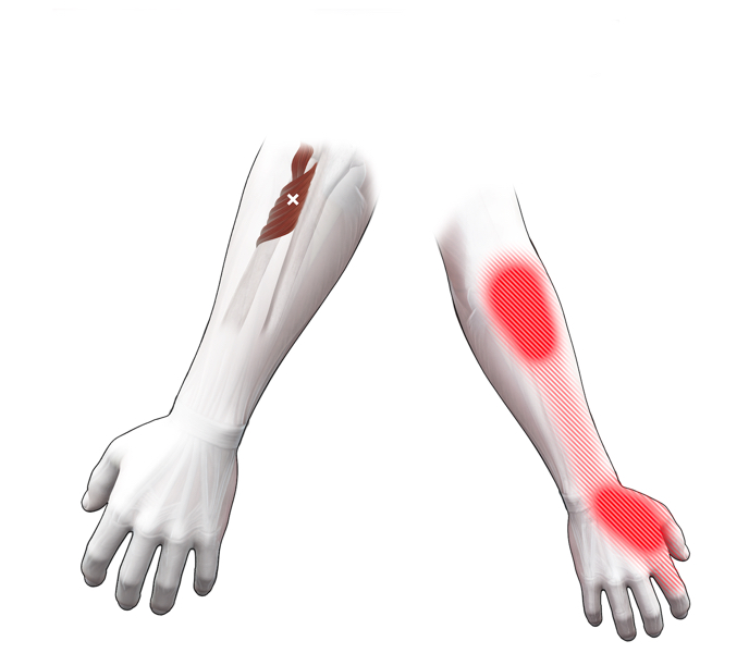 Supinator-Sp-T